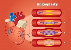 Angioplasty