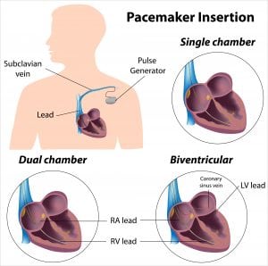 Cardiac resynchronisation therapy