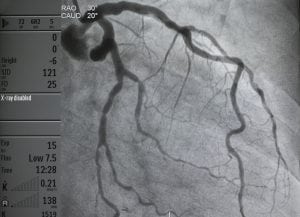 coronary angiogram