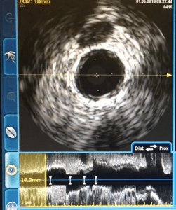 Coronary Intravascular Ultrasound