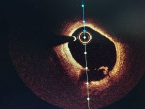 Optical Coherence Tomography