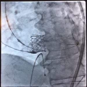 Transcatheter Aortic Valve Insertion